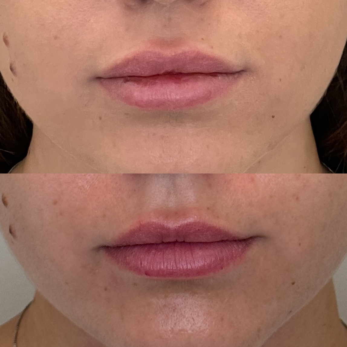 Correção de preenchimento prévio e manutenção da naturalidade