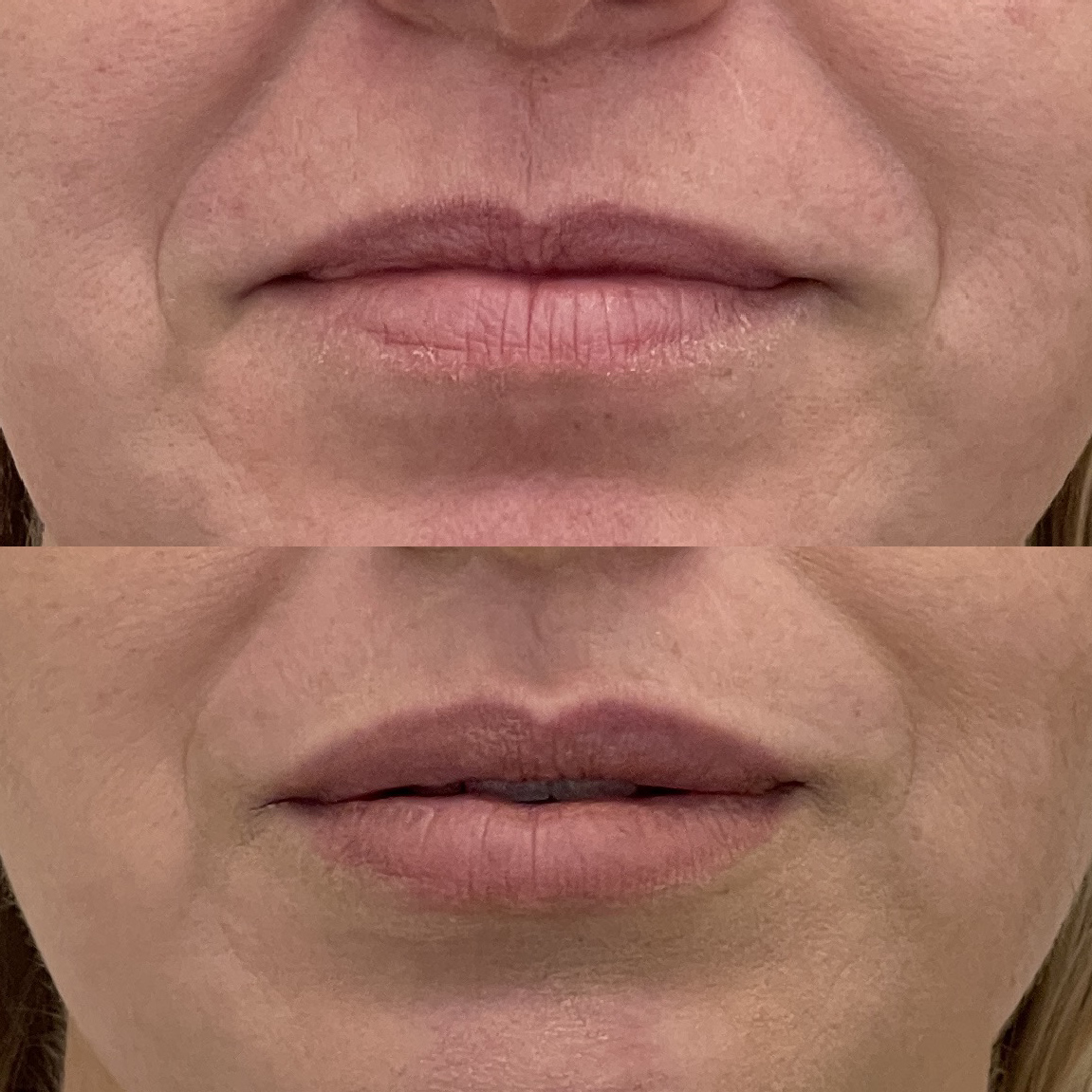 Preenchimento com rejuvenescimento perilabial, pós de 1 mês