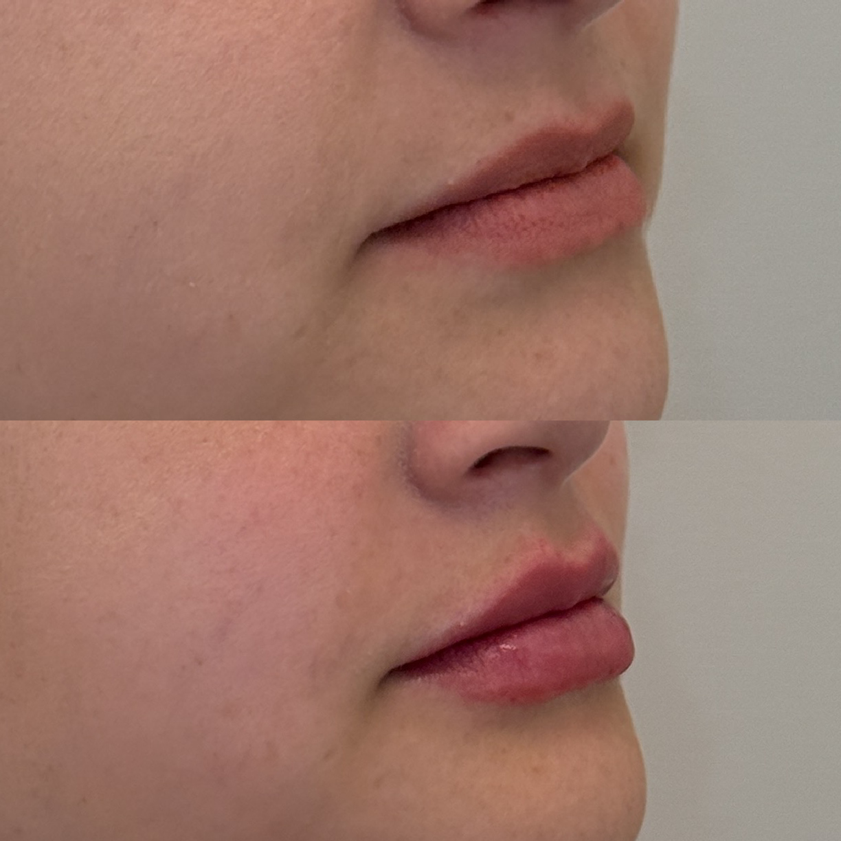 Técnica realizada com SkinBooster, pós imediato