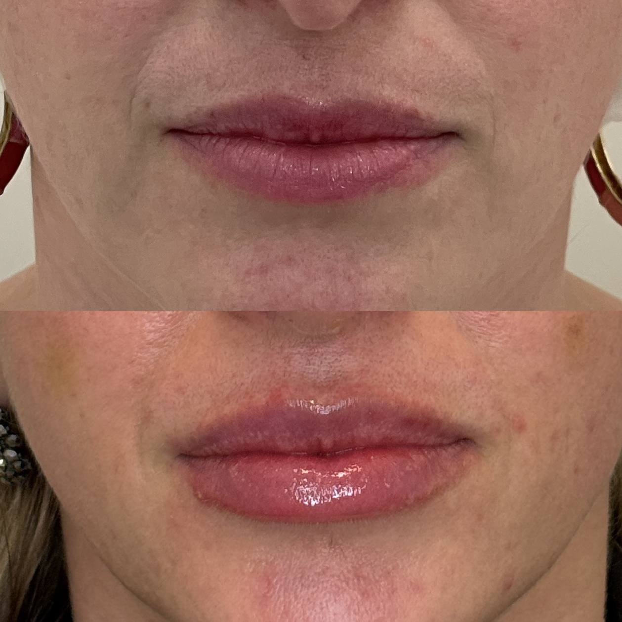 Preenchimento com rejuvenescimento perilabial, pós de 10 dias