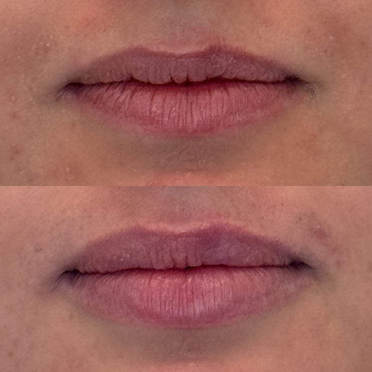 Correção de assimetrias e harmonização do arco do cupido