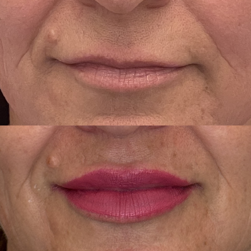 Lábios maduros preenchidos após remoção de gel extravasado