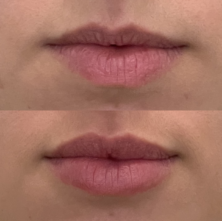 Documentação após 6 meses do procedimento