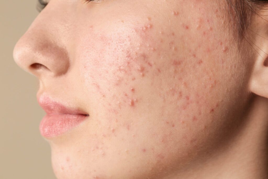 Imagem de acne da mulher adulta